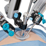 A robot has performed laparoscopic surgery without human